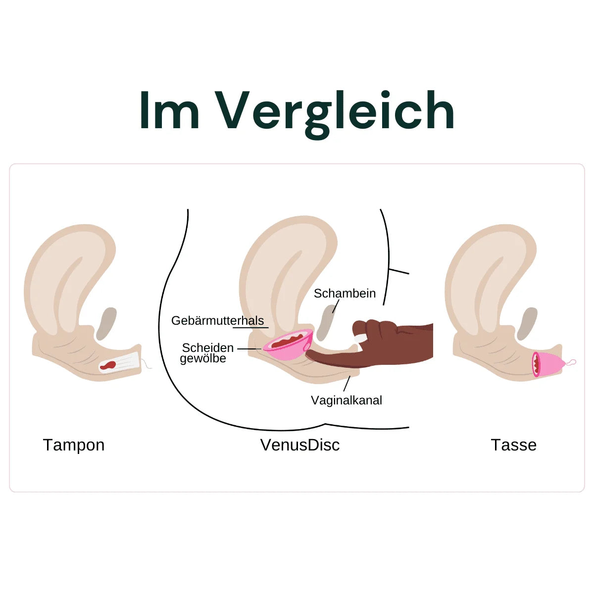 VenusDisc - Menstruationsscheibe