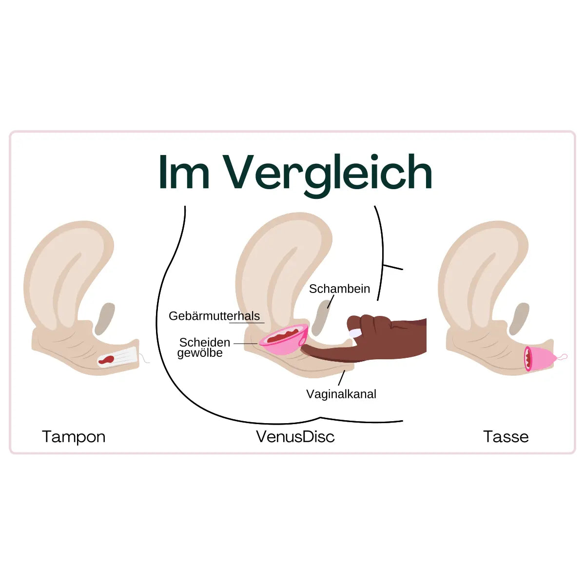 VenusDisc Menstruationsscheibe im Vergleich zu herkömmlichen Hygieneprodukten